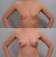 Сергей Свиридов. Грудь без шва