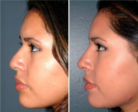 Эндоскопическая ринопластика. Глеб Тумаков