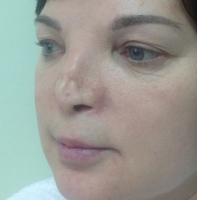 Результат первой неудачной реконструкции носа