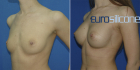Сергей Блохин. Увеличение груди имплантами Eurosilicone