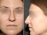 Нос до ринопластики у Тиграна Алексаняна