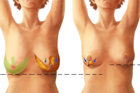 Уменьшение груди