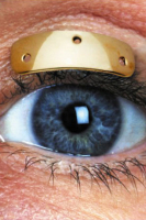 Имплантацией золотого грузика