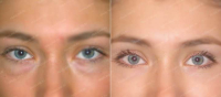 До и после блефаролифтинга