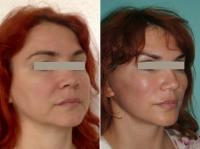 Олег Баниж. Интемпоральный лифтинг