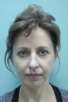 Пациентка до операции у Искорнева