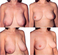 Мария Егорова. Уменьшение груди