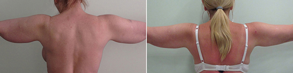 До и после радиочастотной липосакции рук у пластического хирурга Светланы Пшонкиной