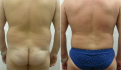 Мужчина до и после липосакции