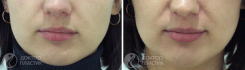 Увеличение объема губ. Клиника DoctorPlastic