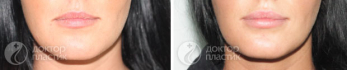 Создание четкого контура губ. Клиника DoctorPlastic