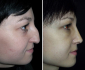 Пациентка Тиграна Алексаняна до и после ринопластики