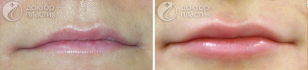 Восстановление утраченного с возрастом объема губ. Клиника DoctorPlastic