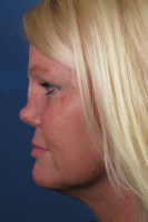 Седловидная деформация носа