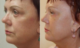 Игорь Белый. Коррекция выворота нижних век методом Cheek-lift