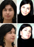 Пластический хирург Валерий Стайсупов. СПИК. Удаление комков Биша