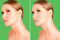 Подтяжка лица нитями АПТОС