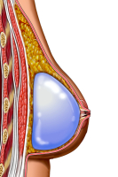 Установка импланта под молочную железу
