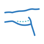 Брахиопластика (пластика рук)