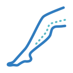 Круропластика (имплантация голени)