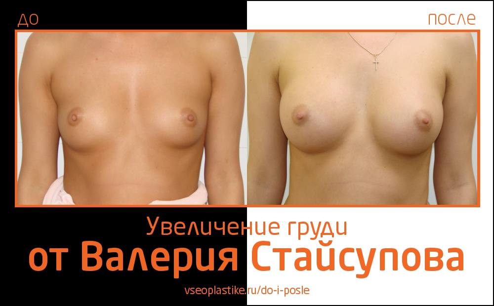 Валерий Стайсупов. Фото до и после увеличения груди
