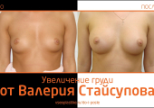 Валерий Стайсупов. Фото до и после увеличения груди
