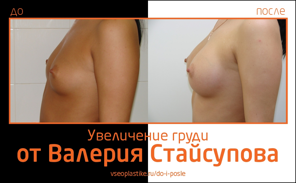Пациентка увеличила грудь в Институте красоты СПИК у Валерия Стайсупова. В ходе операции ей были установлены круглые импланты Natrelle (МакГан), 275 сс.