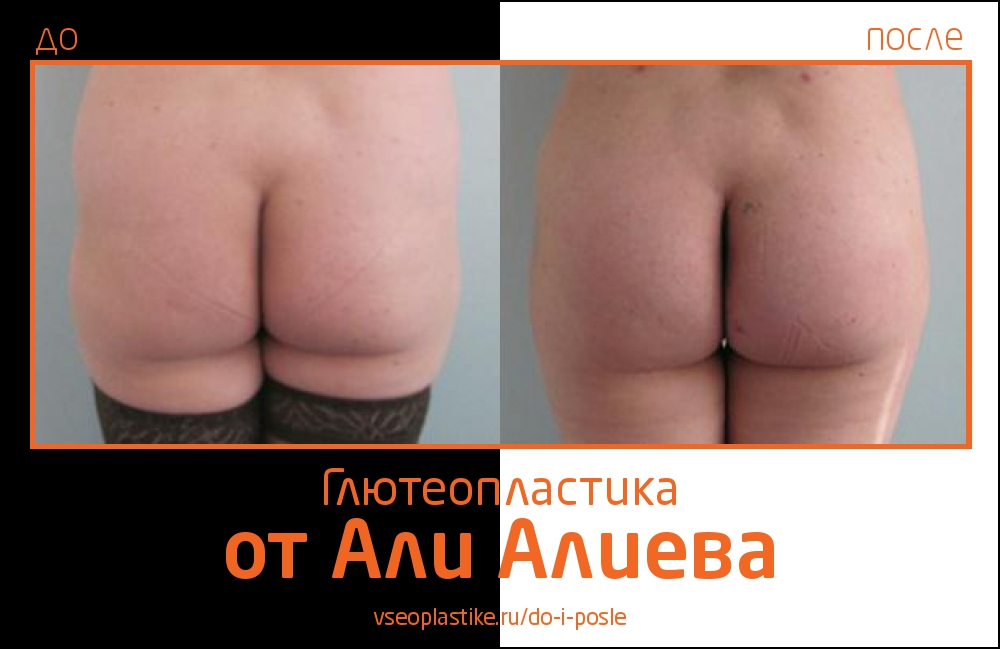 Aliev_glyuteo_1