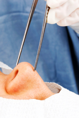 Отеки после ринопластики