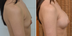 Валерий Стайсупов. Увеличение груди