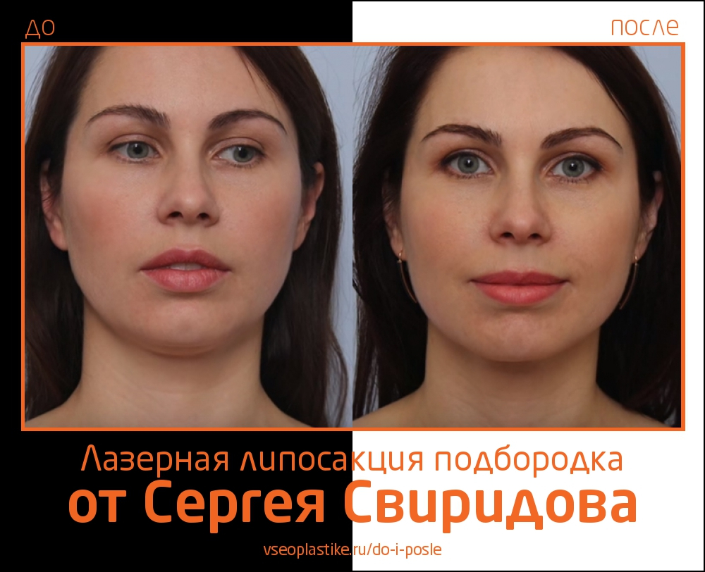 Лазерная липосакция подбородка у Сергея Свиридова
