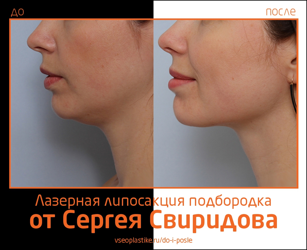 Лазерная липосакция подбородка у Сергея Свиридова