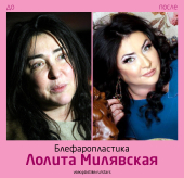 Лолита Милявская до и после блефаропластики