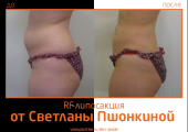 RF-lipo_Pshonkina