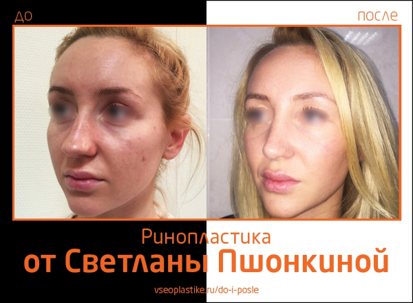 Светлана Пшонкина. Фото до и после ринопластики