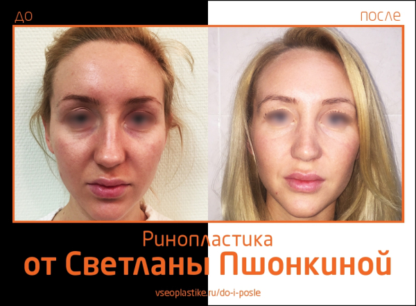 Светлана Пшонкина. Фото до и после ринопластики