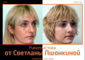 Пациентка Светланы Пшонкиной до и после ринопластики. Предлагаем оценить результат эстетической коррекции носа.