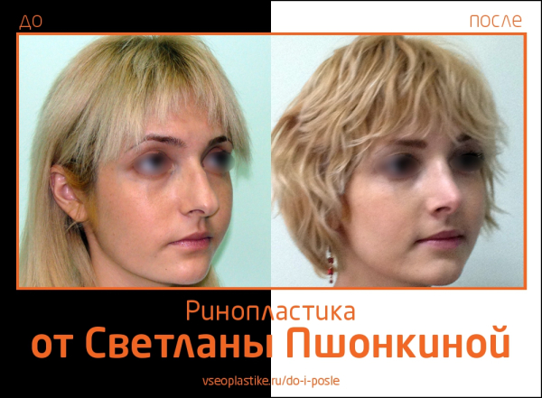 Результаты до и после ринопластики у Пациентки Светланы Пшонкиной
