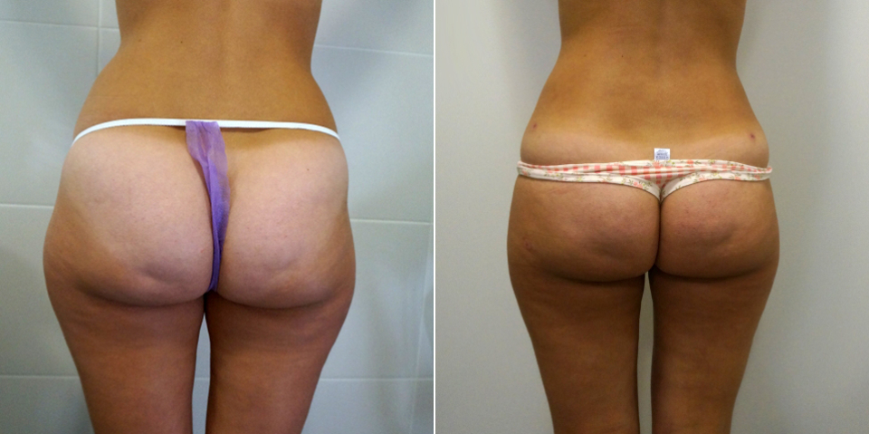 До и после липосакции ягодиц у Доктора Пенаева