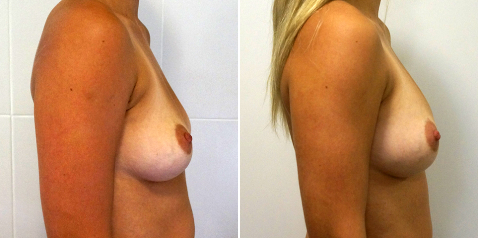 До и после липофилинга груди у доктора Пенаева