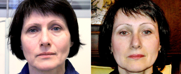 Фото до и после эндоскопического лифтинга у Андрея Ворошкевича