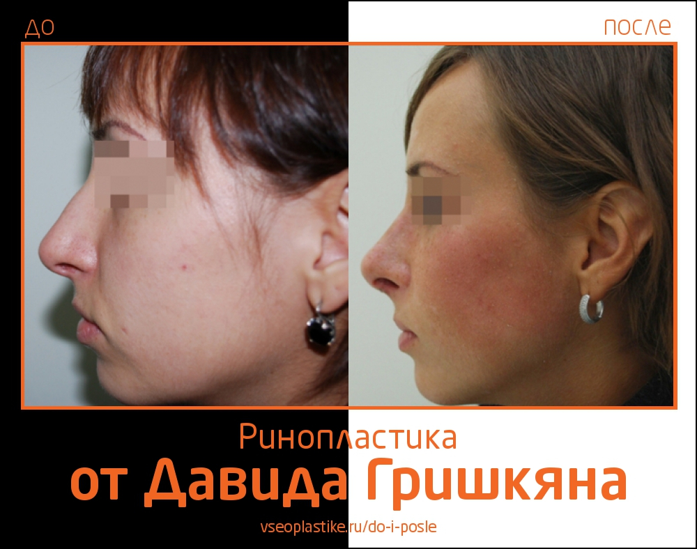 Пациентка Давида Гришкяна до и после ринопластики