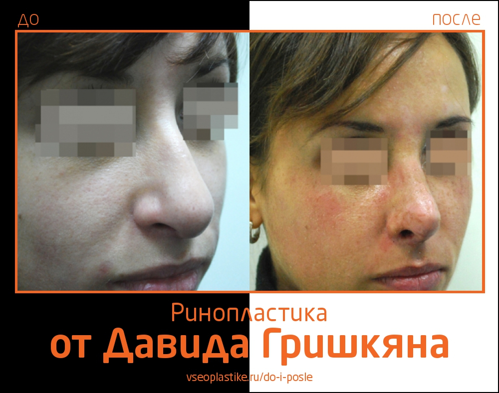 Пациентка Давида Гришкяна до и после ринопластики
