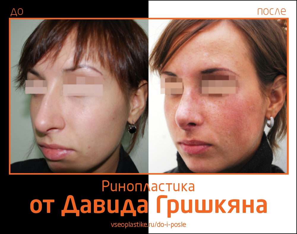 Пациентка Давида Гришкяна до и после ринопластики
