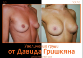 Увеличение груди от Давида Гришкяна