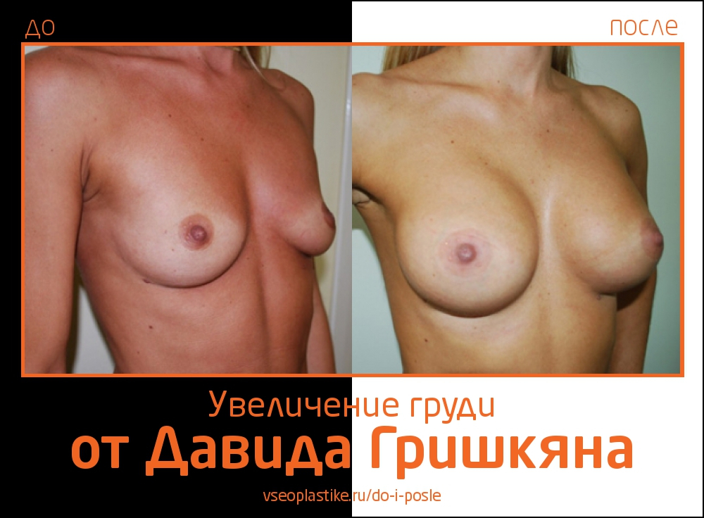 Увеличение груди от Давида Гришкяна