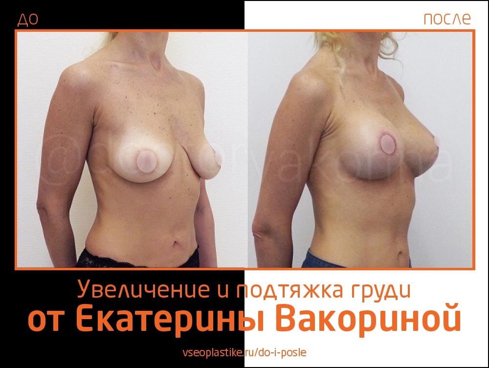 Пациентка Екатерины Вакориной до и после увеличения и подтяжки груди