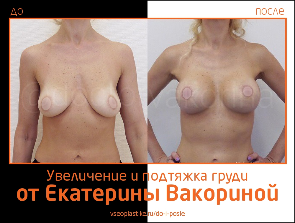 Пациентка Екатерины Вакориной до и после увеличения и подтяжки груди
