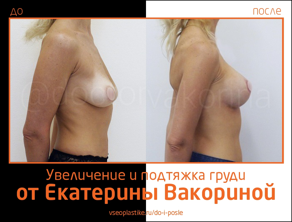Пациентка Екатерины Вакориной до и после увеличения и подтяжки груди