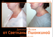 До и после омоложения «Декольте Визаж» у Светланы Пшонкиной